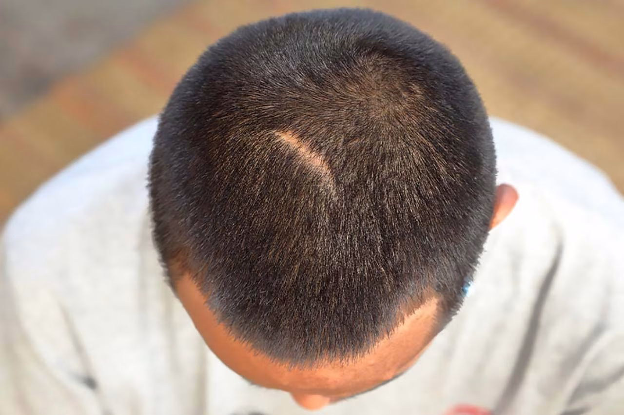 Cicatrizes no Couro Cabeludo: Quando o Transplante Capilar é Possível?
