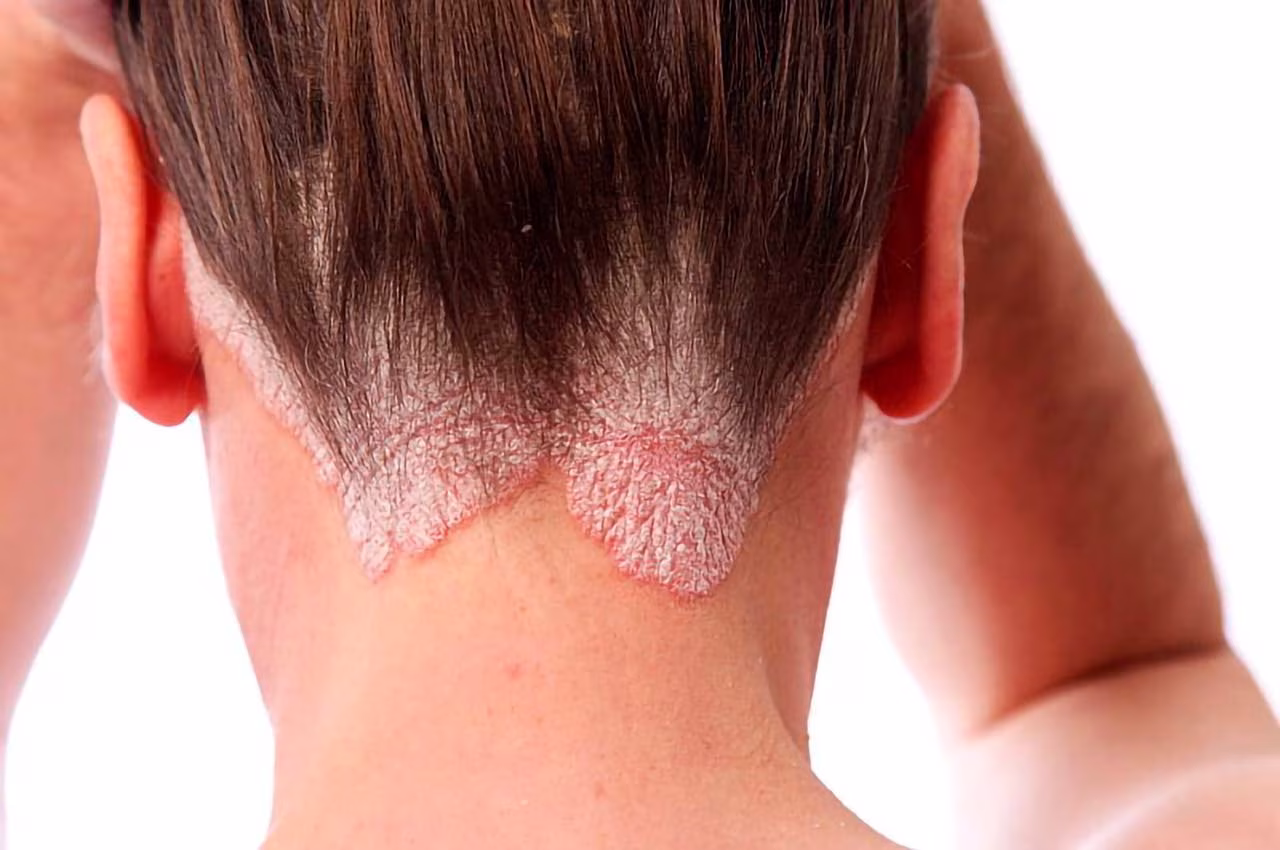 Tinea Capitis: infecção fúngica que pode levar à perda de cabelo